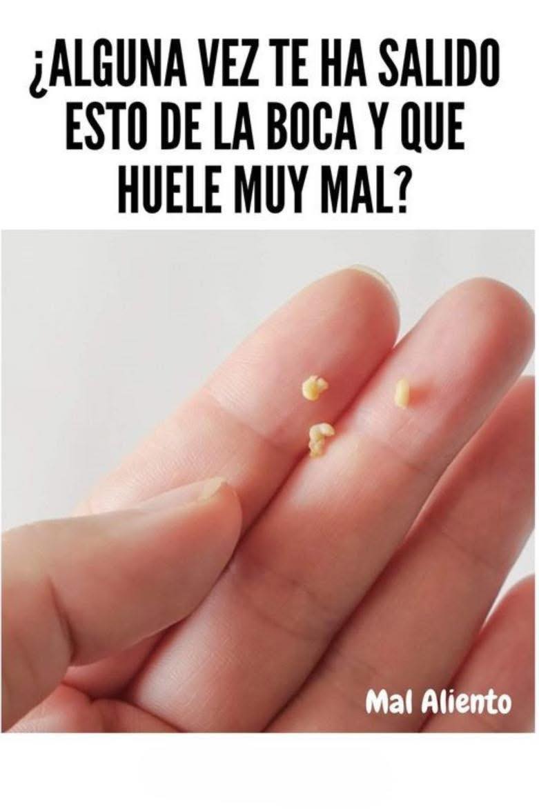 La boca es una de las zonas más sensibles del cuerpo y cualquier cambio puede causar preocupación. Llagas, puntos blancos, ampollas o inflamaciones suelen aparecer por causas comunes, pero también pueden indicar que es momento de prestar más atención. Aquí te explico las razones más frecuentes por las que aparece “algo extraño” en la boca y cuándo conviene cuidarla más. ⭐ 1. Aftas o Llaguitas Son pequeñas heridas dolorosas dentro de la boca. Suelen aparecer por: Estrés Comer algo muy caliente o ácido Morderse accidentalmente Resequedad Aunque son inofensivas, duelen bastante. ⭐ 2. Irritación por Alimentos o Productos Algunos productos pueden irritar la boca y causar: Enrojecimiento Picazón Puntitos blancos Ardor Esto pasa con alimentos ácidos, pasta dental, enjuagues fuertes o especias. ⭐ 3. Mordidas o Golpes Sin Notar Una pequeña mordida accidental puede generar: Hinchazón Un bultito duro Dolor al tocar En la mayoría de los casos, se desinflama solo. ⭐ 4. Acumulación de Placa o Irritación por Cepillado Cepillado muy fuerte, hilo dental brusco o mala higiene pueden causar: Puntos rojos Sangrado Sensibilidad ⭐ 5. Ampollas o Inflamaciones por Calor Beber algo muy caliente puede provocar: Burbujas Ampollitas Sensibilidad Se ven pequeñas pero molestan bastante. ⭐ 6. Cuando aparece un “bulto duro” o una lesión persistente A veces pueden aparecer: Bultos que no duelen Manchas blancas o rojas Lesiones que no desaparecen Zonas engrosadas En estos casos lo más importante es no ignorarlo y observar si cambia con los días. ⚠️ Señales para tener mucho cuidado Si notas algo de lo siguiente, es recomendable buscar orientación profesional: Dolor muy fuerte Mal olor inusual Lesión que crece o no mejora Mucha inflamación Sangrado frecuente Dificultad para comer o hablar Estas señales no significan algo grave por sí solas, pero sí ameritan atención. 👄 Cómo cuidar la boca para evitar molestias Mantén buena higiene bucal Evita reventar ampollas o tocar lesiones Bebe suficiente agua Reduce comidas muy ácidas o picantes Cambia tu cepillo cada 2–3 meses Evita morderte los labios o cachetes Conclusión Si te salió “algo raro” en la boca —sea un puntito blanco, una ampolla o un bultito— lo más común es que se trate de irritaciones simples o llagas pasajeras. Pero si algo no mejora o se ve inusual, es mejor revisarlo con calma y consultar para descartar problemas.