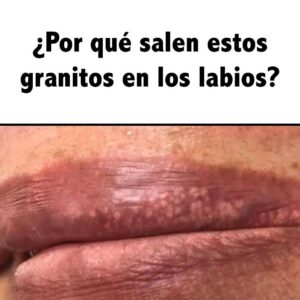 ¿Por Qué Salen Estos Granitos en los Labios? Causas Más Comunes que Debes Conocer Los labios son una de las zonas más sensibles del rostro, y por eso no es raro que aparezcan pequeños granitos, puntitos blancos o inflamaciones que pueden generar molestia o preocupación. Aunque suelen ser inofensivos, conocer sus causas ayuda a entender por qué aparecen y cómo evitar agravarlos. Aquí te explico las razones más comunes por las que surgen estos puntitos o granitos en los labios y cuándo es recomendable prestar atención. ⭐ 1. Poros Obstruidos Así como en el resto del rostro, los labios también pueden tener pequeños poros alrededor que se tapan por: Exceso de grasa Residuos de maquillaje Cremas muy pesadas Sudor Esto puede generar pequeños puntitos o granitos que se ven como acné leve. ⭐ 2. Piel Seca o Irritada Cuando los labios están resecos, agrietados o irritados por el clima, es normal que aparezcan: Puntitos rojos Pequeñas inflamaciones Sensación áspera La resequedad puede hacer que la piel reaccione con pequeños granitos. ⭐ 3. Reacción a un Producto Los labios reaccionan rápido a: Labiales Bálsamos Pasta dental Alimentos ácidos Perfumes en productos Si aparece irritación, picazón o varios puntitos juntos, puede deberse a sensibilidad. ⭐ 4. Folículos Pilosos La parte externa de los labios (alrededor del borde) tiene folículos de vello muy pequeños. Cuando se inflaman o se tapan, pueden verse como: Puntitos blancos Pequísimos “granitos” Irritación localizada A veces puede pasar después de depilarse o afeitarse cerca de la zona. ⭐ 5. Pequeñas Glándulas Naturales (Fordyce) Muchísimas personas tienen puntitos blanquecinos o amarillentos en el borde de los labios. Son glándulas sebáceas naturales, visibles en algunas personas y completamente normales. No son infecciones y no duelen. ⭐ 6. Cambios Hormonales Los cambios hormonales pueden hacer que la piel: Produzca más grasa Se irrite con facilidad Forme pequeños granos en zonas sensibles Los labios no son la excepción. 👄 ¿Qué puedes hacer? Mantener los labios hidratados Evitar reventar o tocar los granitos Usar productos suaves y sin perfume Retirar bien el maquillaje Evitar lamberse los labios (los irrita más) ⚠️ ¿Cuándo prestar atención? Si los granitos: Duelen Aumentan muy rápido Se acompañan de fiebre o malestar No mejoran en varios días Irritan demasiado Es mejor consultar a un profesional para una revisión segura. Conclusión Los granitos en los labios suelen deberse a causas comunes como poros tapados, resequedad, irritación o sensibilidad a productos. En la mayoría de los casos no representan un problema serio y desaparecen solos con cuidados básicos.