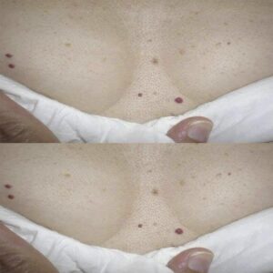 ¿Te han salido puntos rojos en la piel? Esto es lo que tu cuerpo podría estar intentando decirte