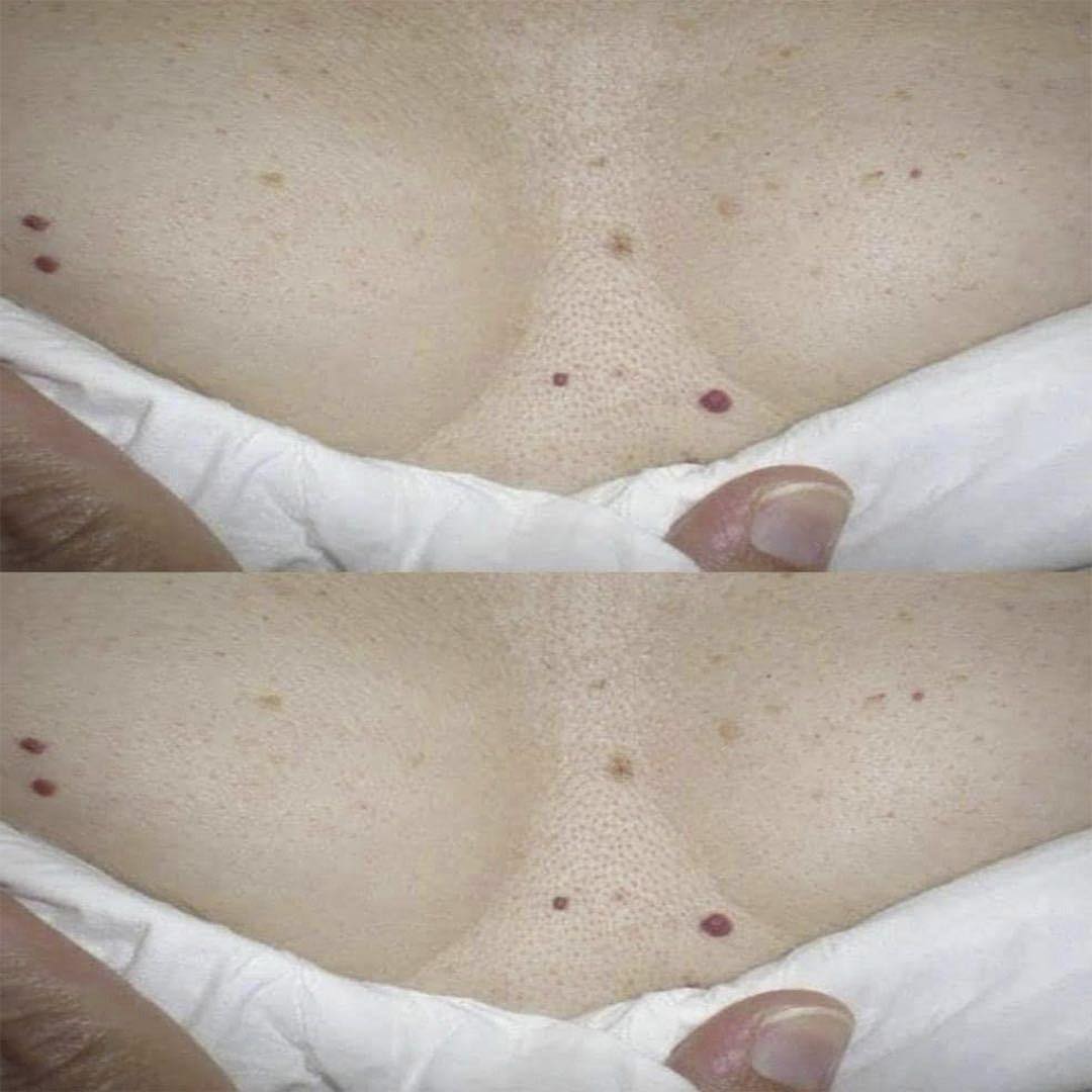 ¿Te han salido puntos rojos en la piel? Esto es lo que tu cuerpo podría estar intentando decirte