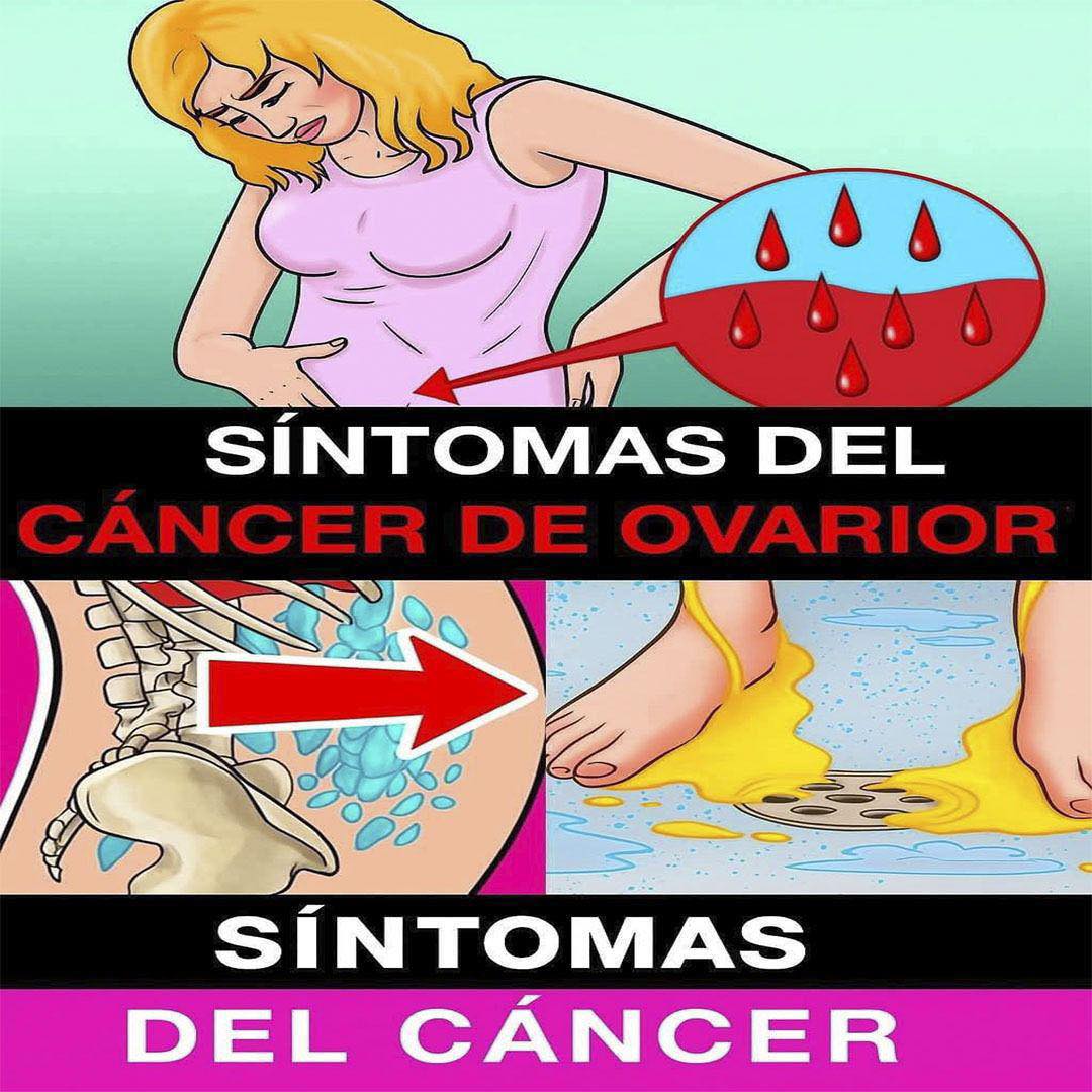 🌸 Cáncer de Ovarios: Lo Que Toda Mujer Debería Saber
