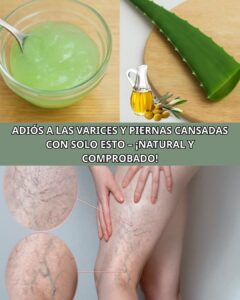 aloe vera varices piernas cansadas