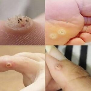 Verrugas plantares: lo que debes saber para reconocerlas, tratarlas y prevenirlas Verrugas plantares: lo que debes saber para reconocerlas, tratarlas y prevenirlas