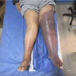 Cuando una pierna se inflama y se torna morada: señales que no debes ignorar