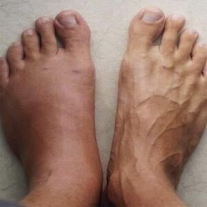 Hinchazón en los pies: una señal que no deberías ignorar
