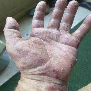 Dermatitis en las manos: cuando la piel habla más fuerte que las palabras