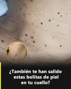 Qué son los acrocordones y por qué aparecen: guía clara para identificarlos