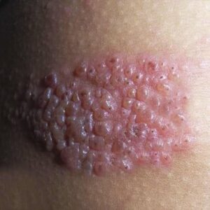 Tipos de erupciones en la piel