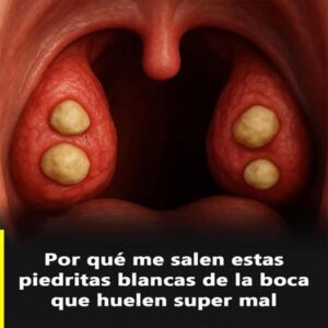 Que son los tonsilolitos y como eliminarlos Que son los tonsilolitos y como eliminarlos