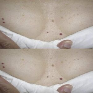 ¿Te han salido puntos rojos en la piel? Esto es lo que tu cuerpo podría estar intentando decirte