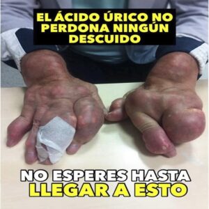 Ácido úrico: Síntomas y Tratamientos Naturales Ácido úrico: Síntomas y Tratamientos Naturales