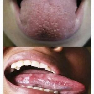 ¿Por qué tengo la lengua blanca? Lo que tu cuerpo quiere decirte