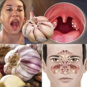 El ajo y su sorprendente poder para aliviar garganta y sinusitis