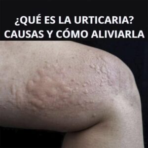 Tipos de erupciones en la piel