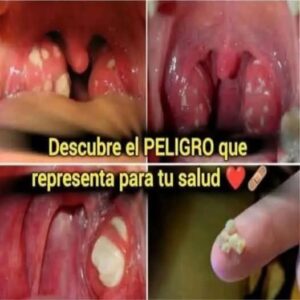 Bolitas blancas en la garganta = MAL ALIENTO Bolitas blancas en la garganta = MAL ALIENTO