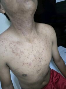 Granitos y Manchas en el Pecho y Cuello: ¿Qué Significa y Cómo Eliminarlo? IMG_7256