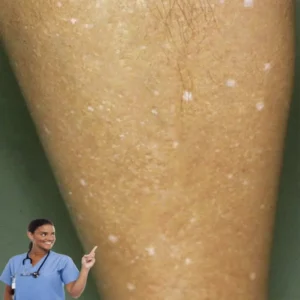 ¿Qué hay detrás de esas manchas blancas en tu piel?