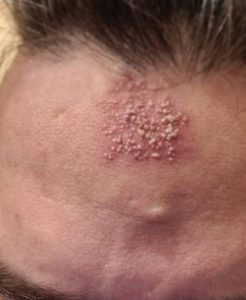 ¿Te salió esto en la frente? Podría ser una señal que tu cuerpo está enviando y muchos ignoran