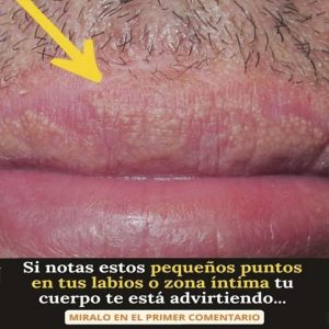 ⚠️ Si Te Están Saliendo Estos Granitos en los Labios o Zona Íntima, Esto es lo que Debes Saber ⚠️ Si Te Están Saliendo Estos Granitos en los Labios o Zona Íntima, Esto es lo que Debes Saber