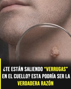 Aunque muchas personas les llaman verrugas, estas no son verrugas… esta podría ser la verdadera razón
